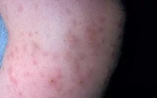 Атопический дерматит: особенности возникновения и протекания заболевания